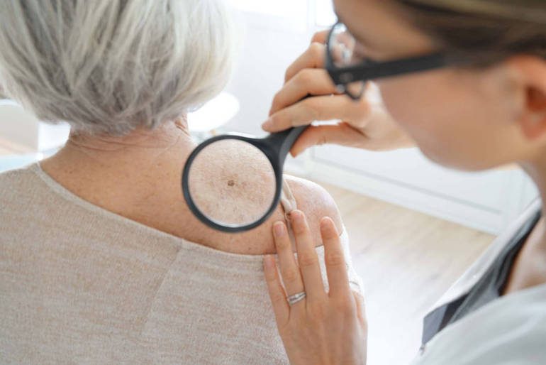 Prevenzione del melanoma e controllo della pelle