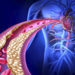 Prevenzione dell'ipercolesterolemia