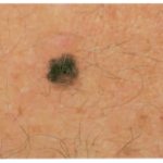 Riconoscere i Segni del Melanoma