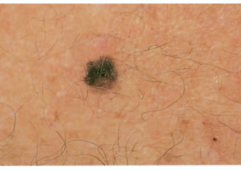 Riconoscere i Segni del Melanoma