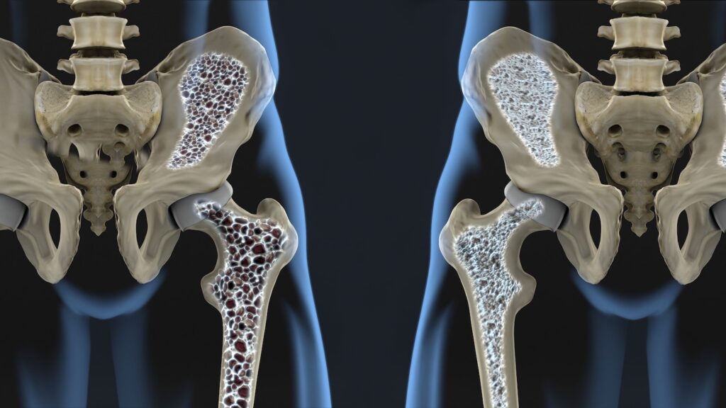 Ridurre il Rischio di Osteoporosi