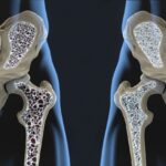 Ridurre il Rischio di Osteoporosi