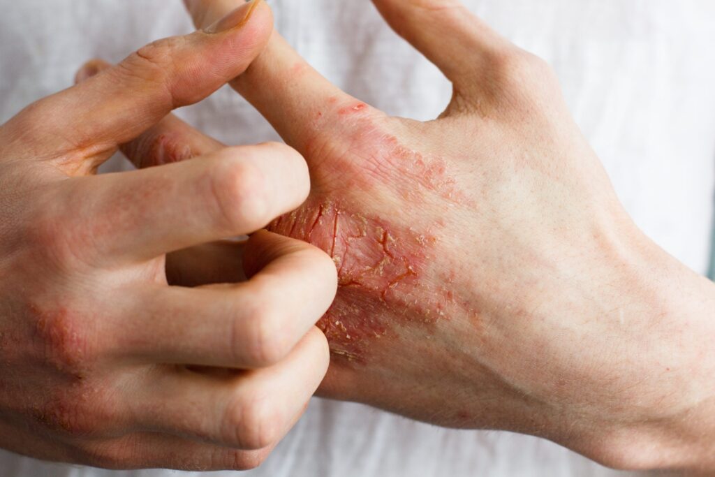 Malattie della pelle come eczema e psoriasi