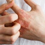 Malattie della pelle come eczema e psoriasi