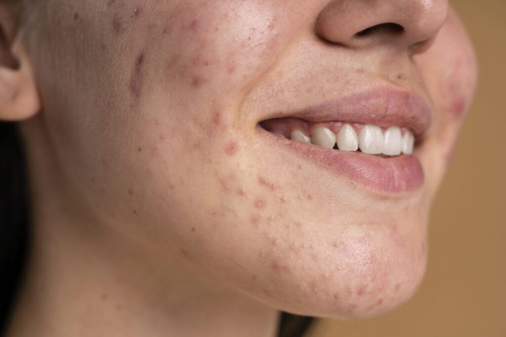 Rosacea e Fattori Ambientali