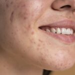 Rosacea e Fattori Ambientali