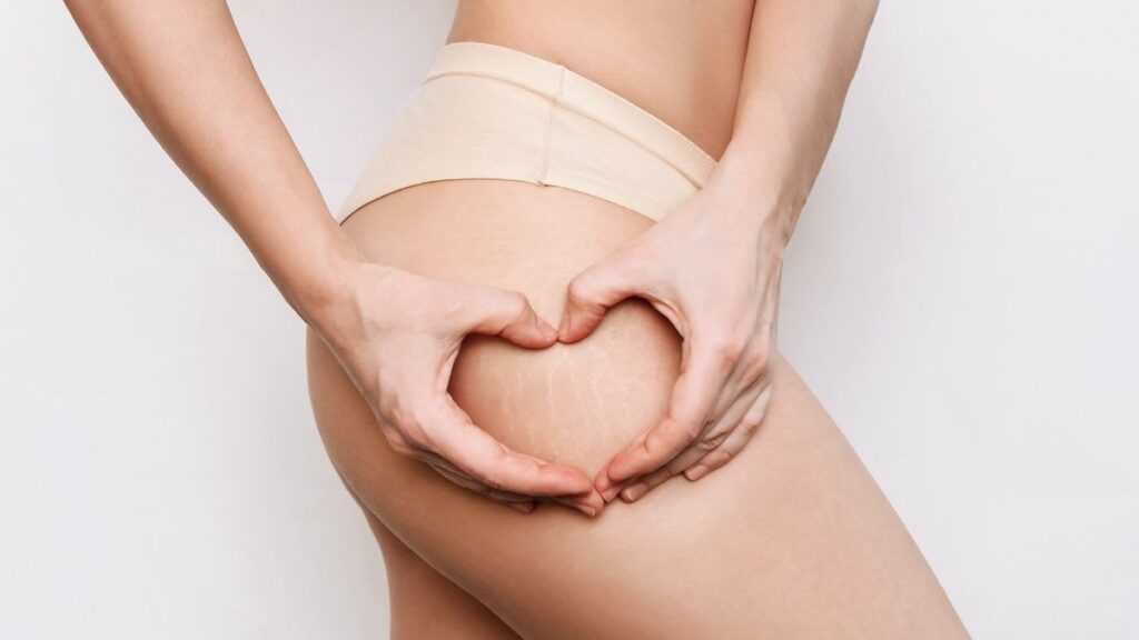 Prevenzione delle Smagliature