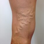 Vene varicose e dolore alle gambe