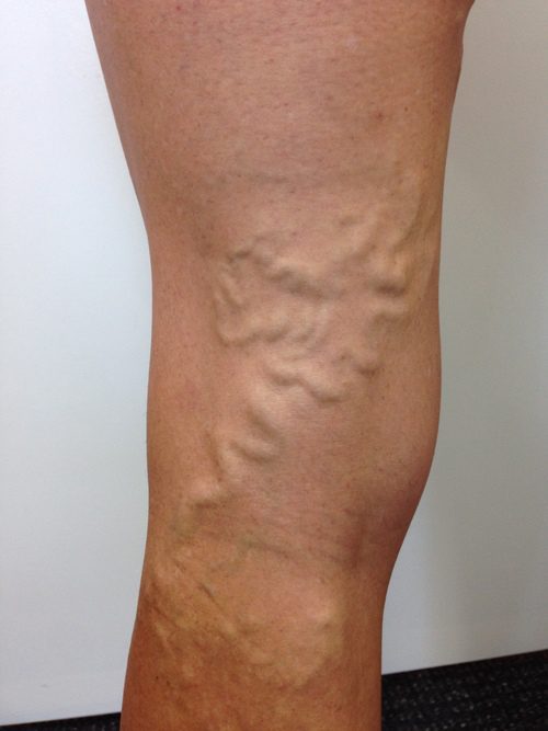 Vene varicose e dolore alle gambe