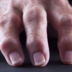 Effetti dell'obesità sull'artrite