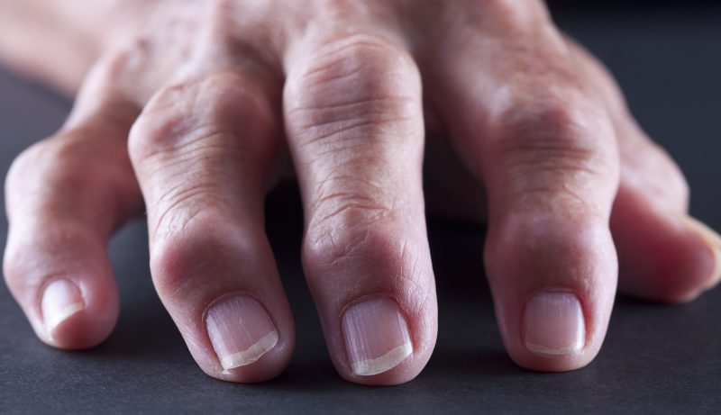 Effetti dell'obesità sull'artrite