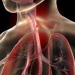Consumo di alcol e rischio di cancro esofageo