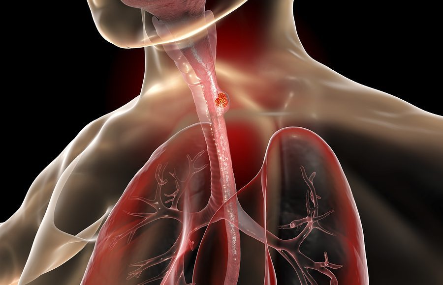 Consumo di alcol e rischio di cancro esofageo