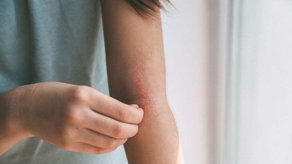 Gestione dell'Eczema