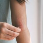 Gestione dell'Eczema