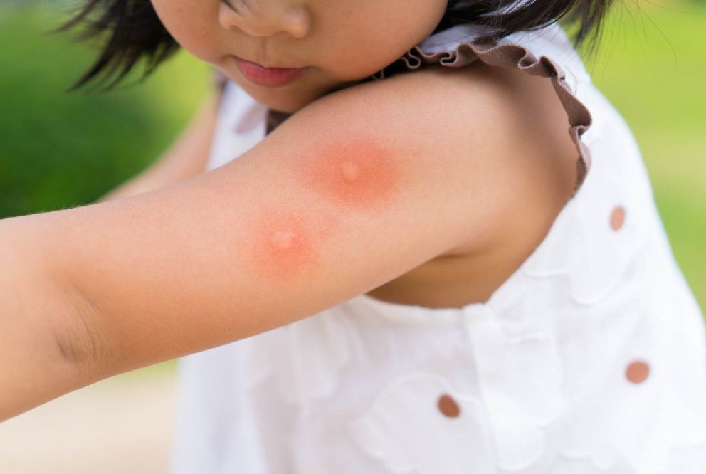 Evitare di essere punti dalle zanzare