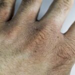 Screpolatura delle mani che non passa