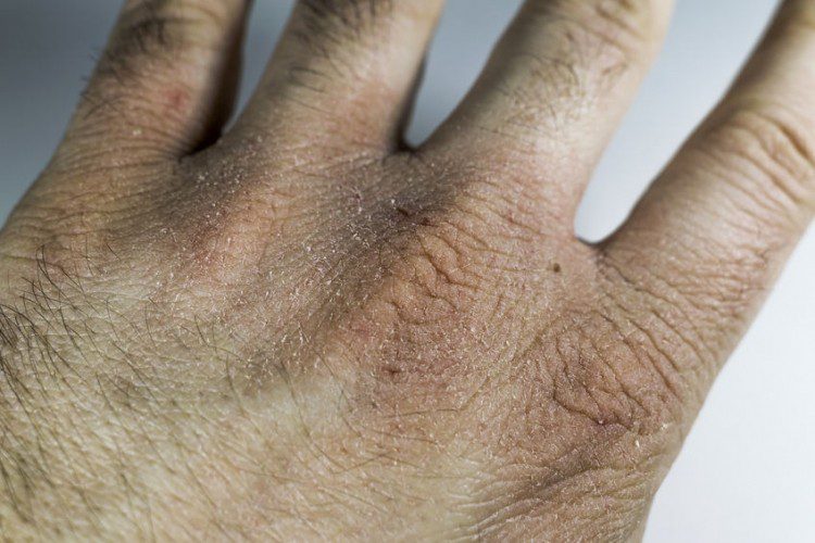 Screpolatura delle mani che non passa