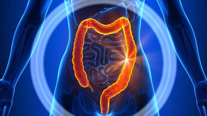 Grassi e zuccheri nel mirino del tumore al colon