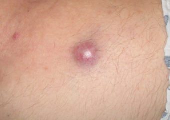 Come Capire di Avere un Tumore alla Pelle
