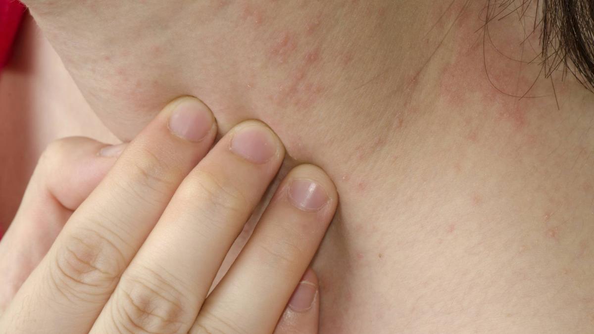 Allergie che Possono Essere Mortali