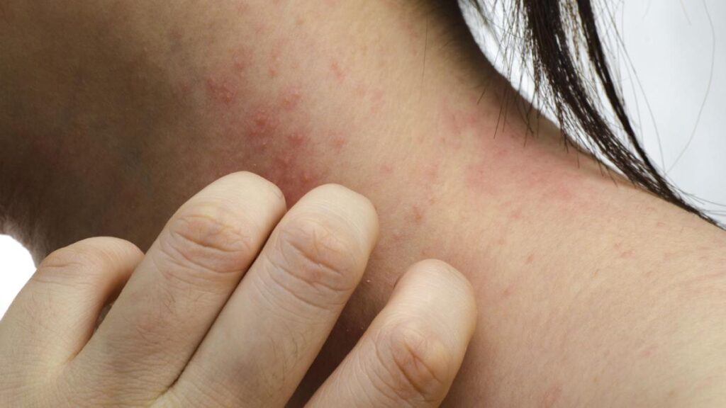 Consigli per la Gestione dell'Eczema