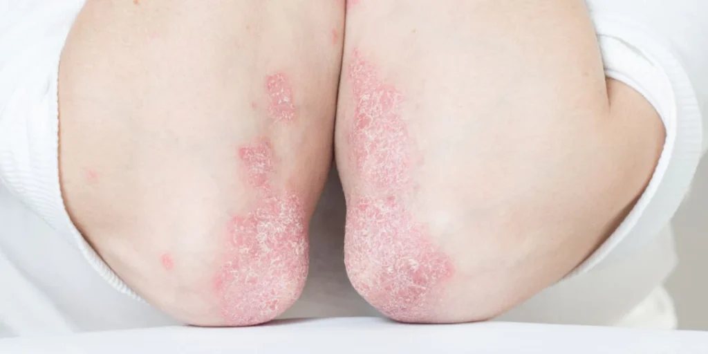 Consigli per Gestire la Psoriasi