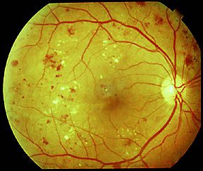 Dieta per la Prevenzione della Retinopatia Diabetica