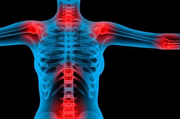 Riconoscere la fibromialgia in modo precoce