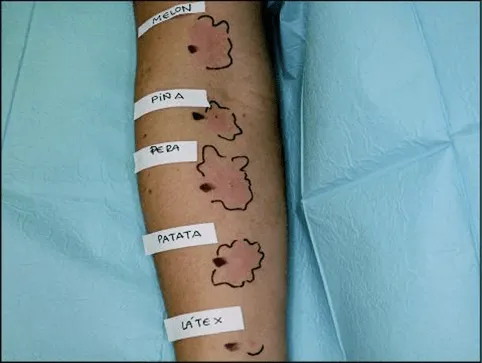 Le fasi che portano all&rsquo;intolleranza