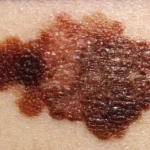 Prevenire il melanoma nel modo giusto