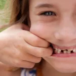 sognare perdere denti