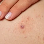 Brufoli dopo la depilazione
