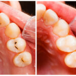 Mal di denti dopo mangiato