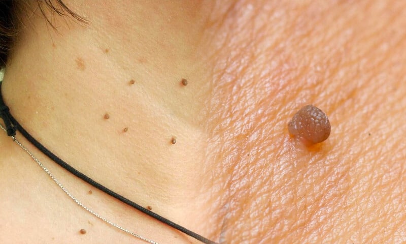 5 consigli utili per identificare i fibromi penduli