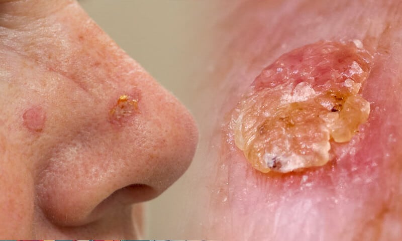 Come eliminare le croste della cheratosi?