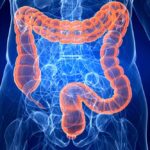 cancro al colon retto cosa non bere