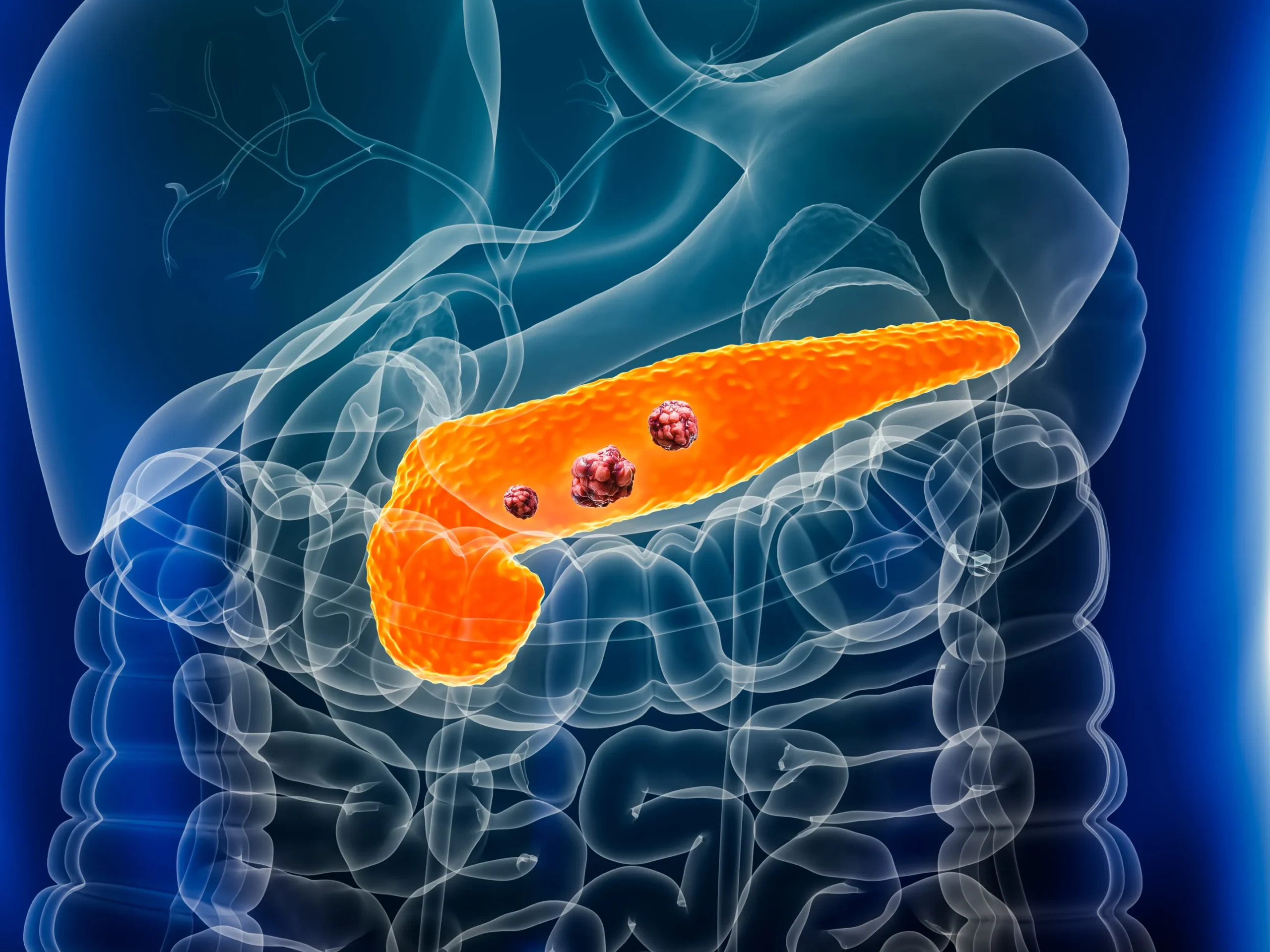Carcinoma al Pancreas: 5 Cose da Non Sottovalutare