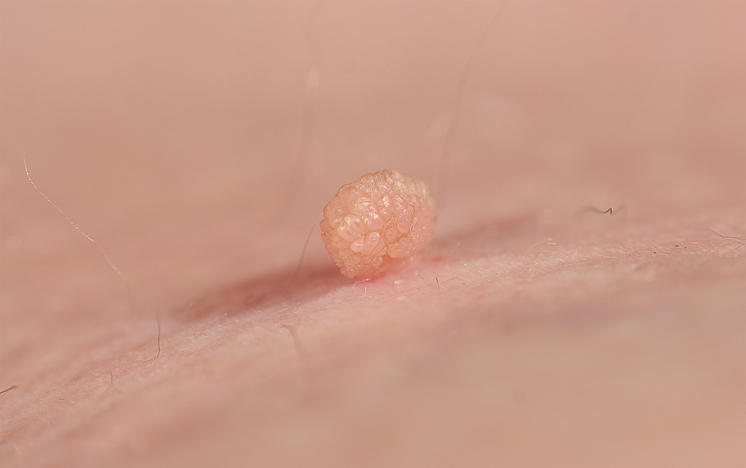 i fibromi penduli sono contagiosi