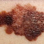 3 sintomi per capire se un neo si è trasformato in melanoma