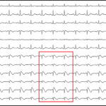 5 segnali per riconoscere la sindrome di Brugada
