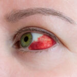 Cosa fare se si rompe una vena oculare