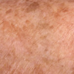 macchie scure sulla pelle perchè compaiono