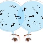 miodesopsie mosche volanti negli occhi