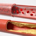 3 rischi del Colesterolo alle stelle e assenza di sintomi