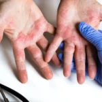 Eczema-aggressivo-sulle-mani