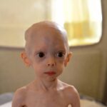 Sindrome di Cockayne: Aspettative di Vita, Sintomi della Malattia