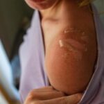 eritema solare, di cosa si tratta e come rimediare