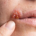 herpes labiale