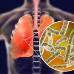 legionella sintomi cause e cure